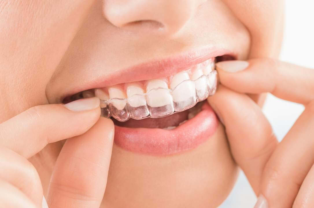 Aparelho Invisível Invisalign Araucária