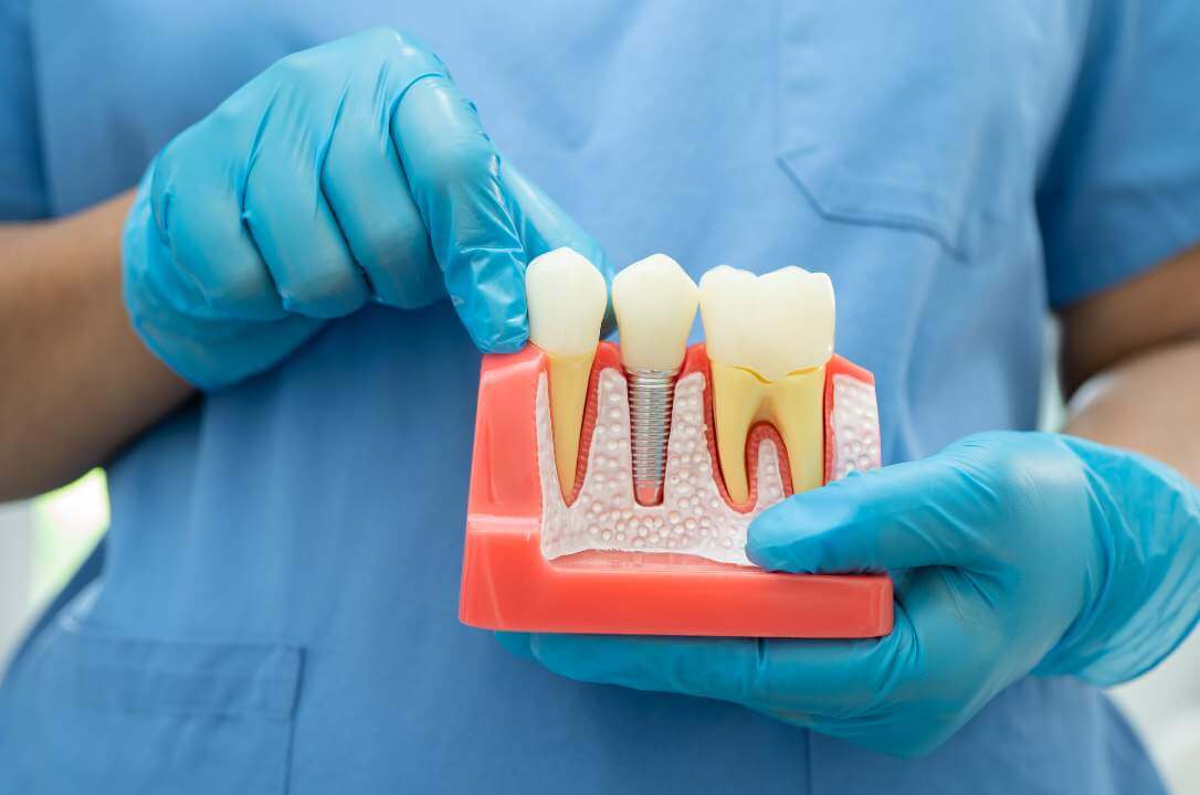 implantes dentários em araucária sorriso